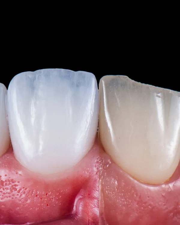 Vollkeramische Veneers — Detailaufnahme der Keramikoberfläche