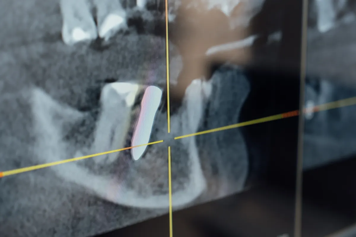 Zu wenig Knochen für ein Implantat — biologische Augmentation