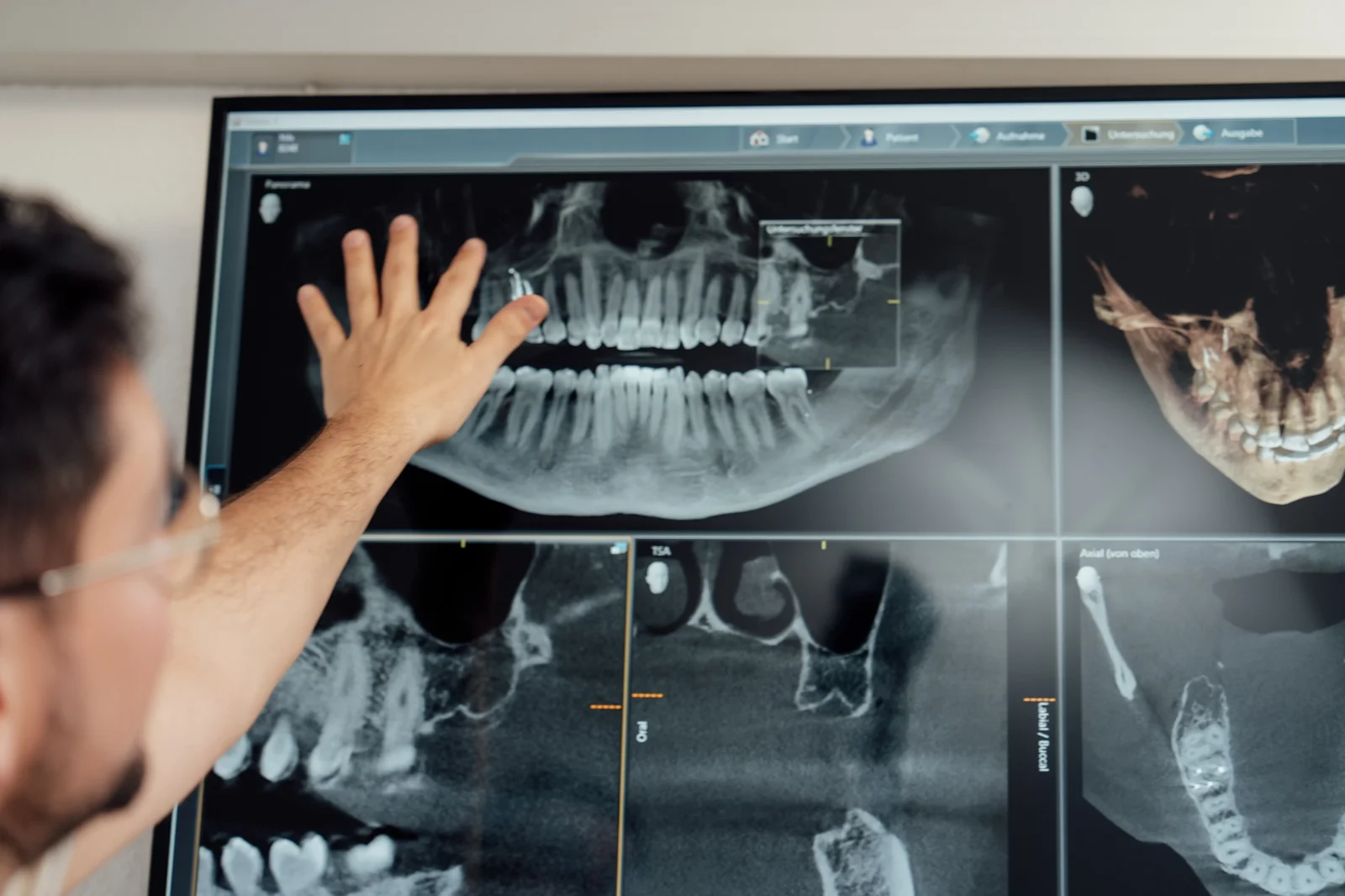 DVT-Diagnostik — dreidimensionale Analyse versteckter Kieferherde in unserer Praxis