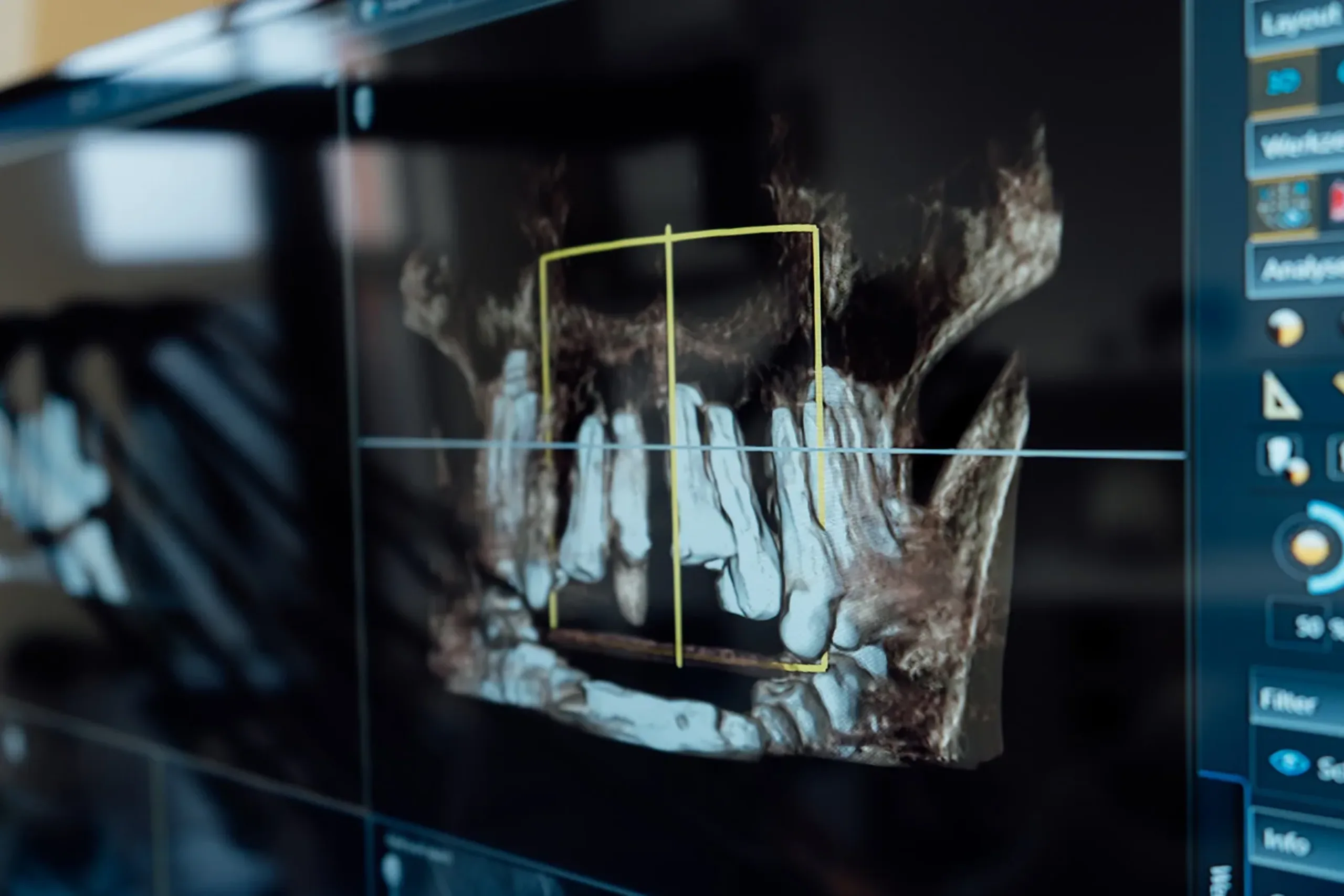 3D-DVT-Diagnostik zur exakten Implantatplanung