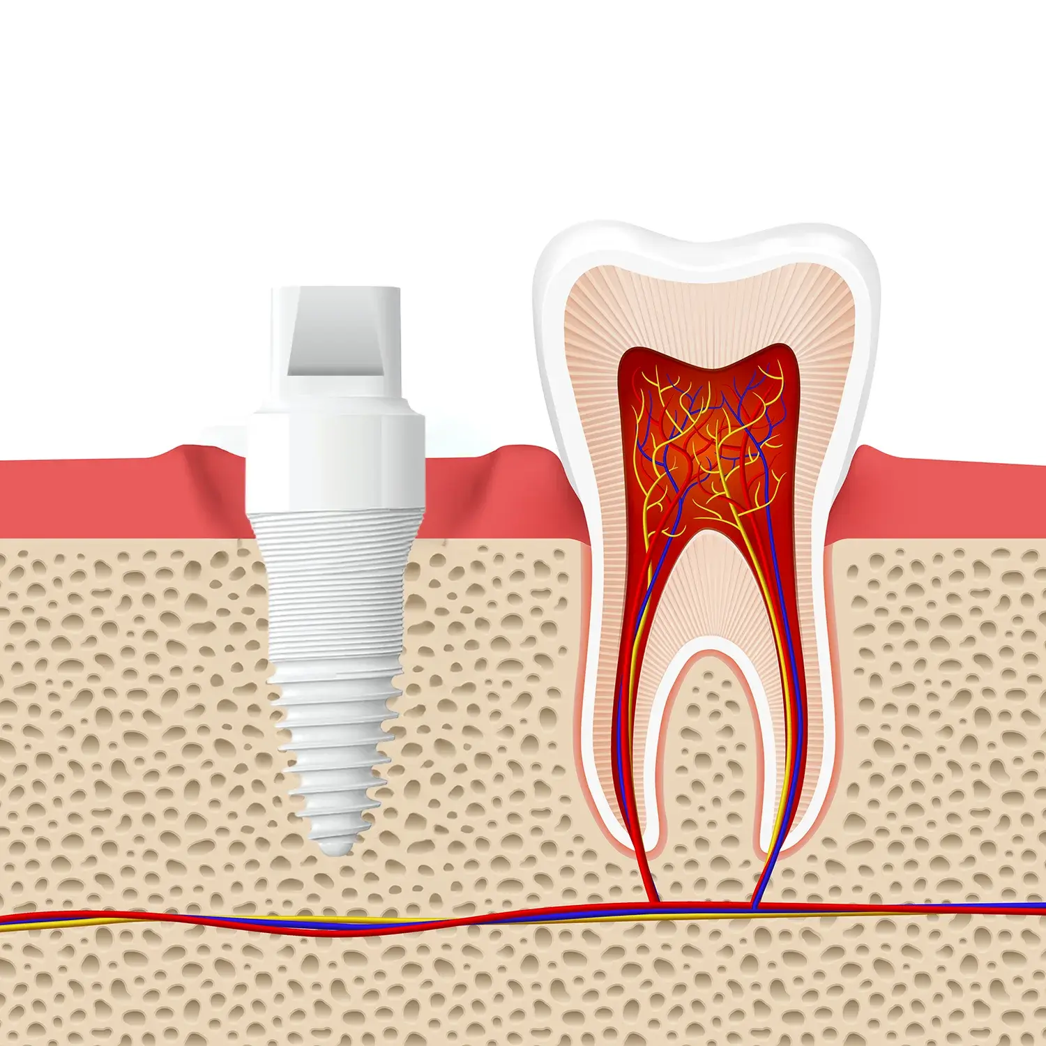 Keramikimplantat — Gesamtansicht inkl. Aufbau