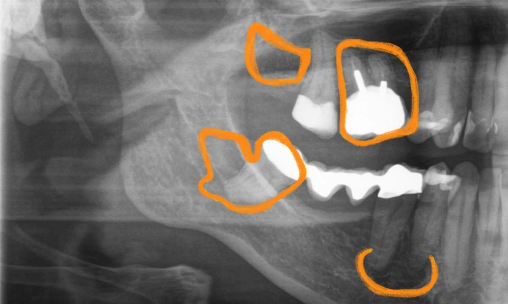 DVT-Diagnostik zur Störfeldsuche